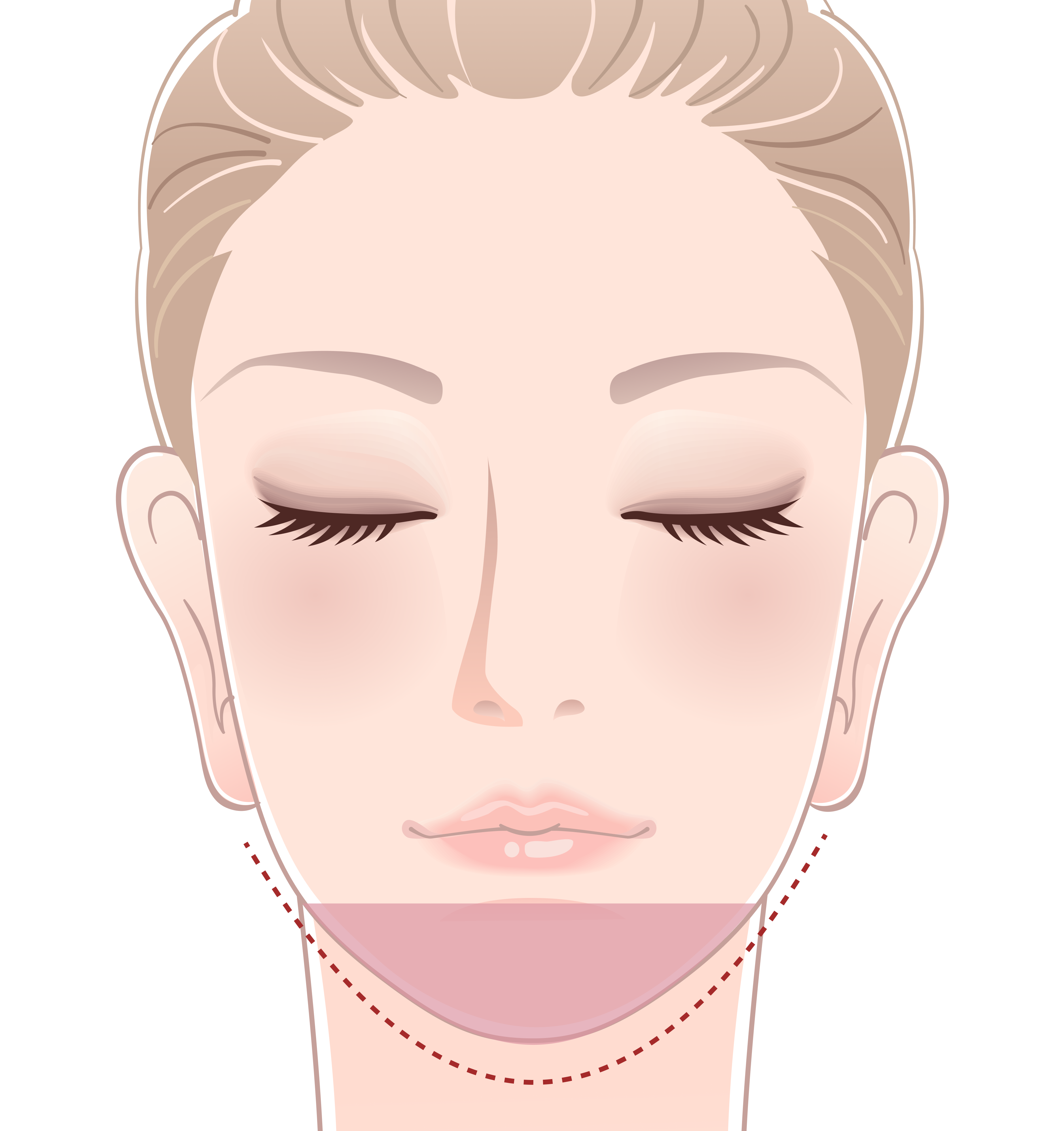 顎のヒアルロン酸注入