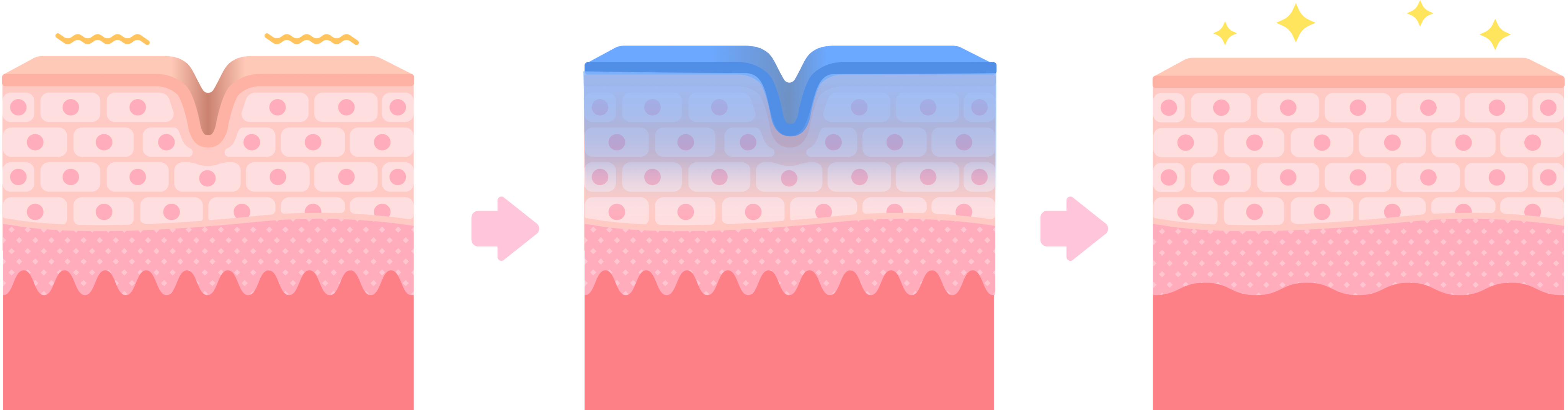 マッサージピール