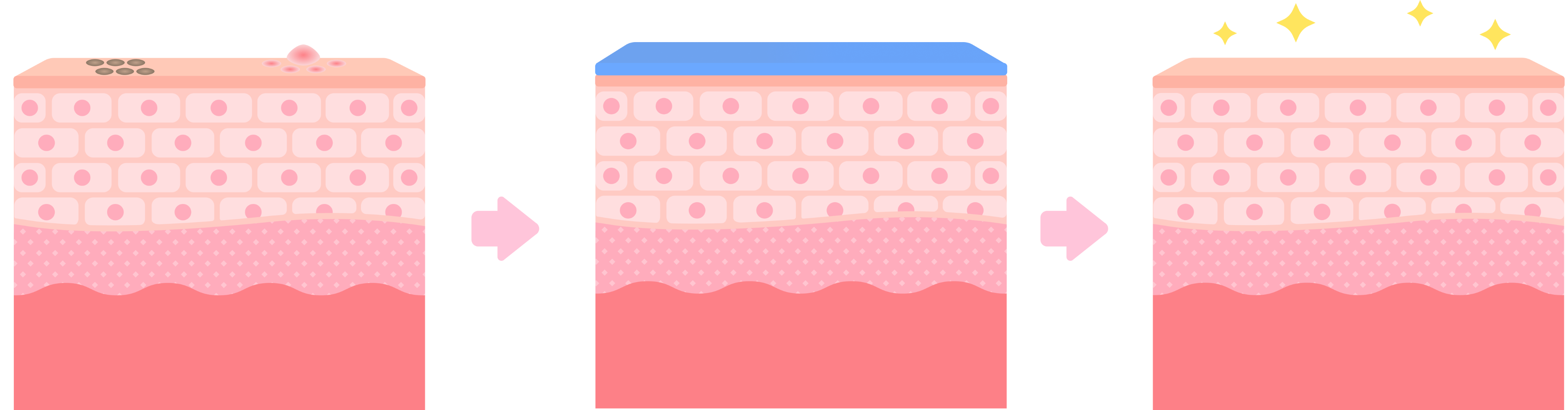 サリチル酸ピーリング