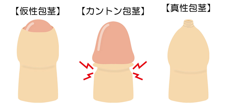 包茎術について
