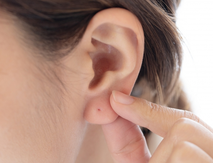 なぜ医療機関でのピアス穴あけが重要か